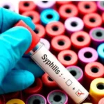 Kenya records over 1.42 million Syphilis tests as infections fall to 9,000 cases