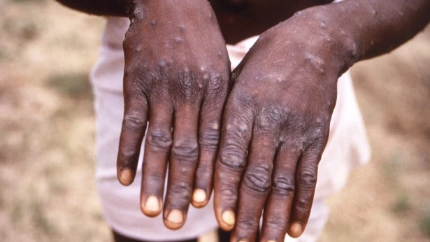 Murang’a confirms fifth Mpox case as county steps up response