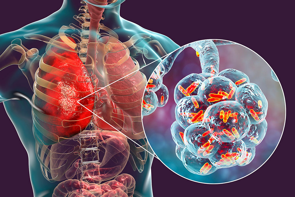 One dead, 12 infected in major Legionnaires' disease outbreak in Sydney